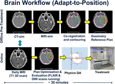 High grade glioma radiation therapy on a high field 1.5 Tesla MR-Linac - workflow and initial experience with daily adapt-to-position (ATP) MR guidance: A first report